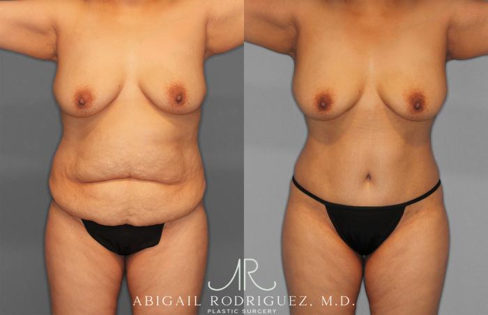 Before & After Tummy Tuck Case 258309 View 1 View in Houston, TX