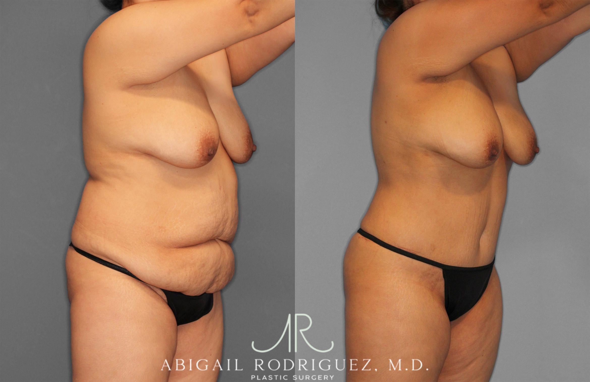 Before & After Tummy Tuck Case 258309 View 10 View in Houston, TX