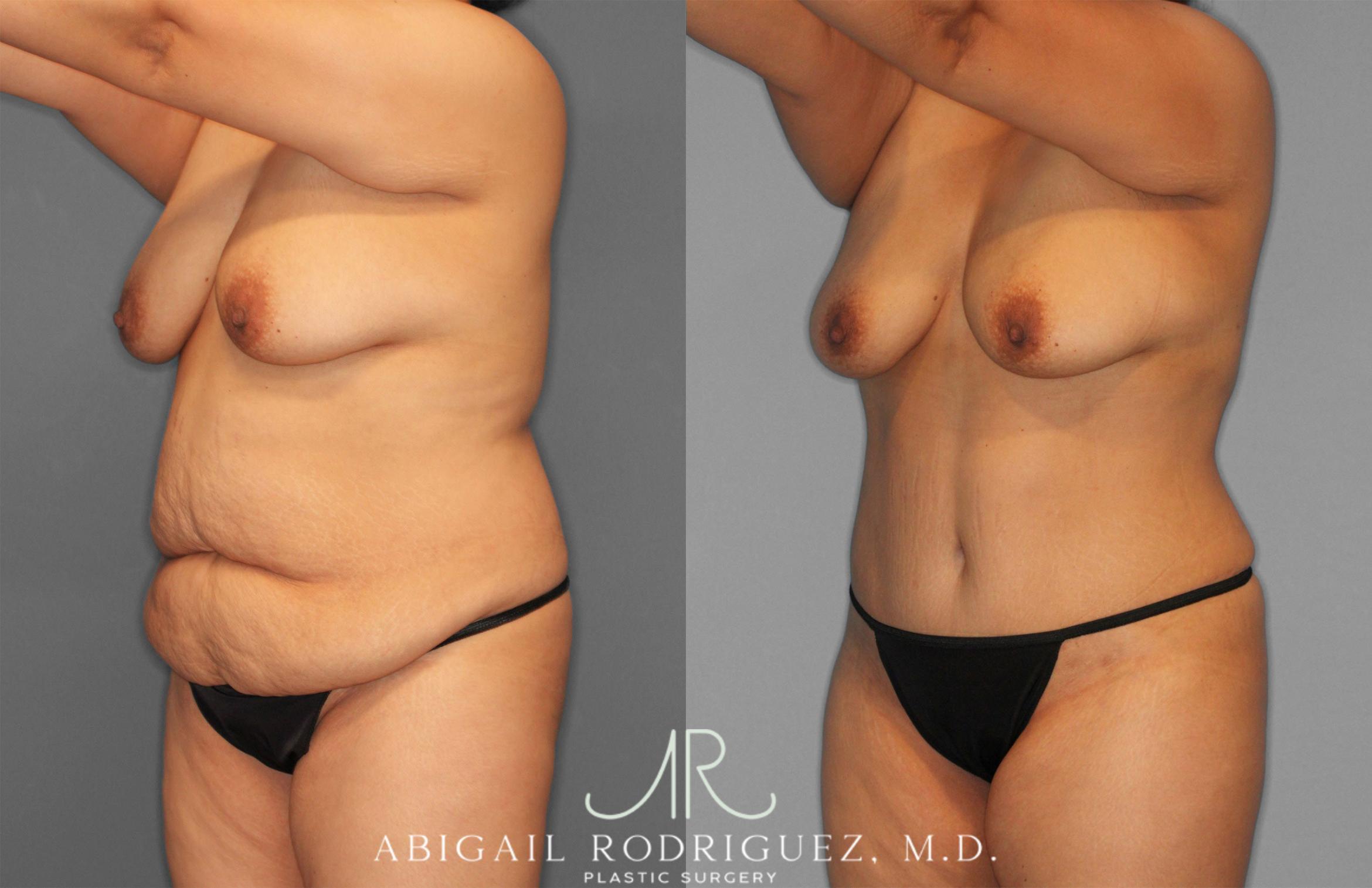 Before & After Tummy Tuck Case 258309 View 2 View in Houston, TX