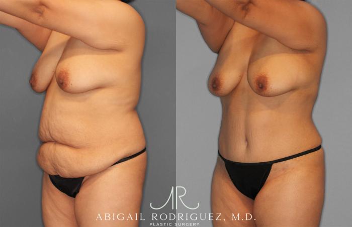 Before & After Tummy Tuck Case 258309 View 2 View in Houston, TX