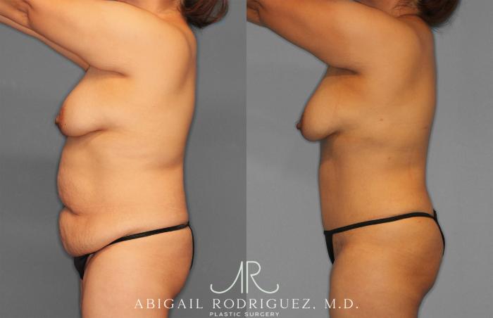 Before & After Tummy Tuck Case 258309 View 3 View in Houston, TX