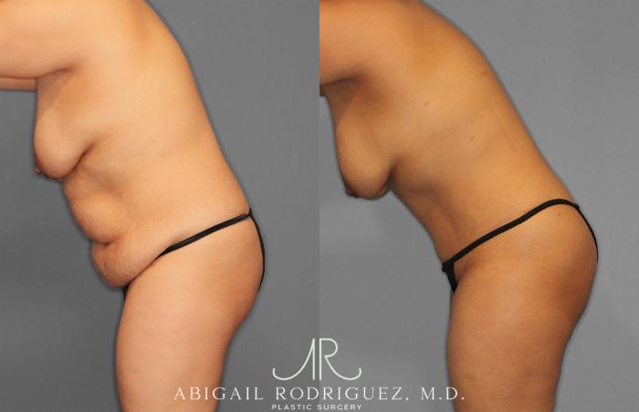 Before & After Tummy Tuck Case 258309 View 4 View in Houston, TX