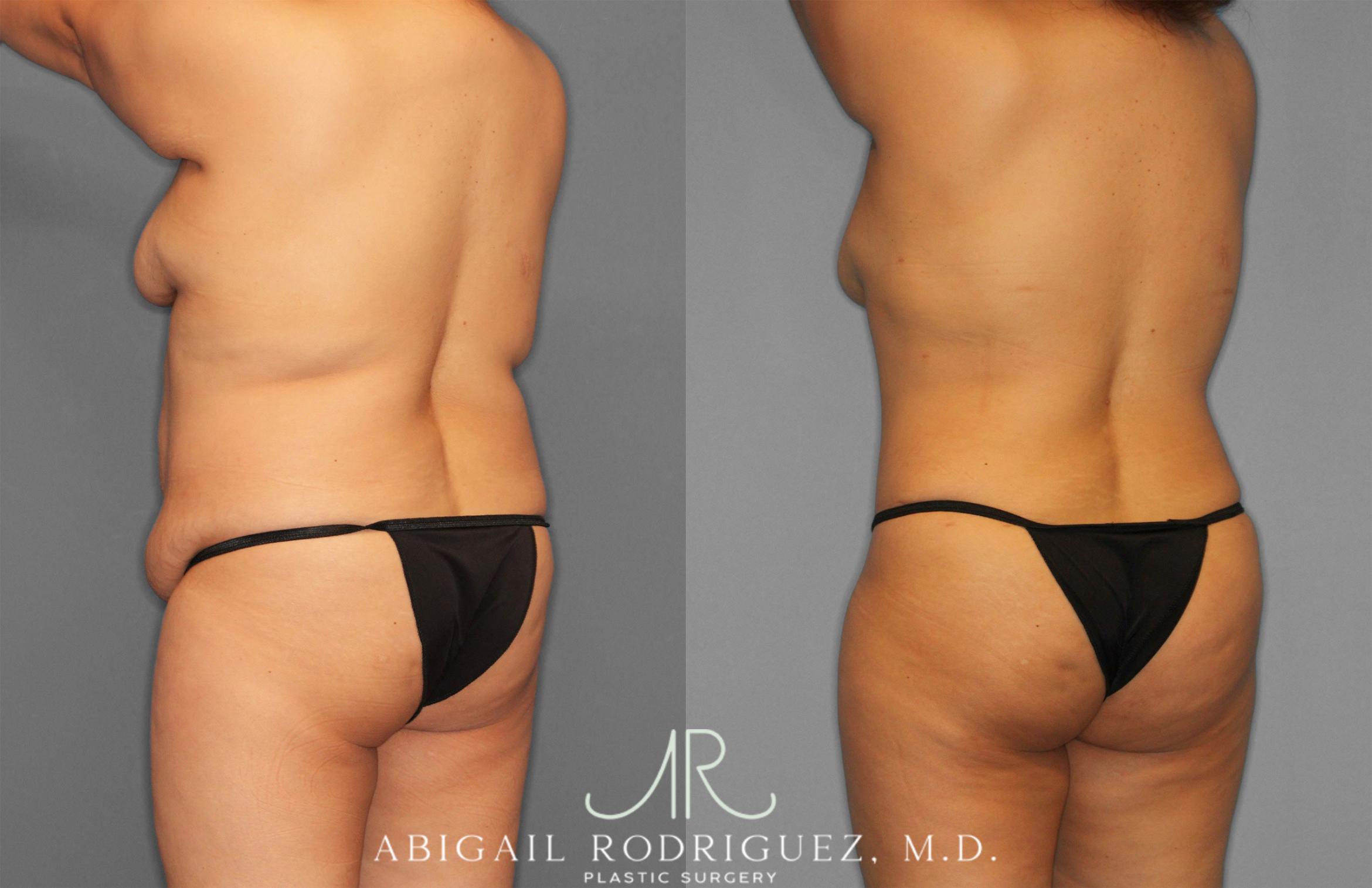 Before & After Tummy Tuck Case 258309 View 5 View in Houston, TX