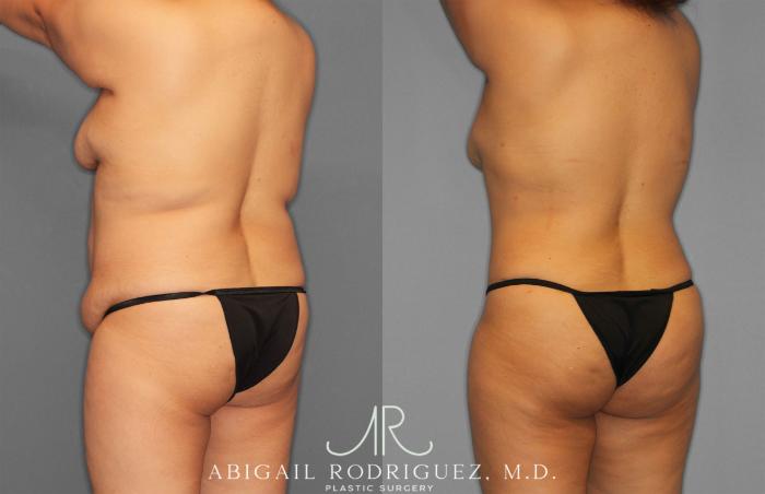 Before & After Tummy Tuck Case 258309 View 5 View in Houston, TX