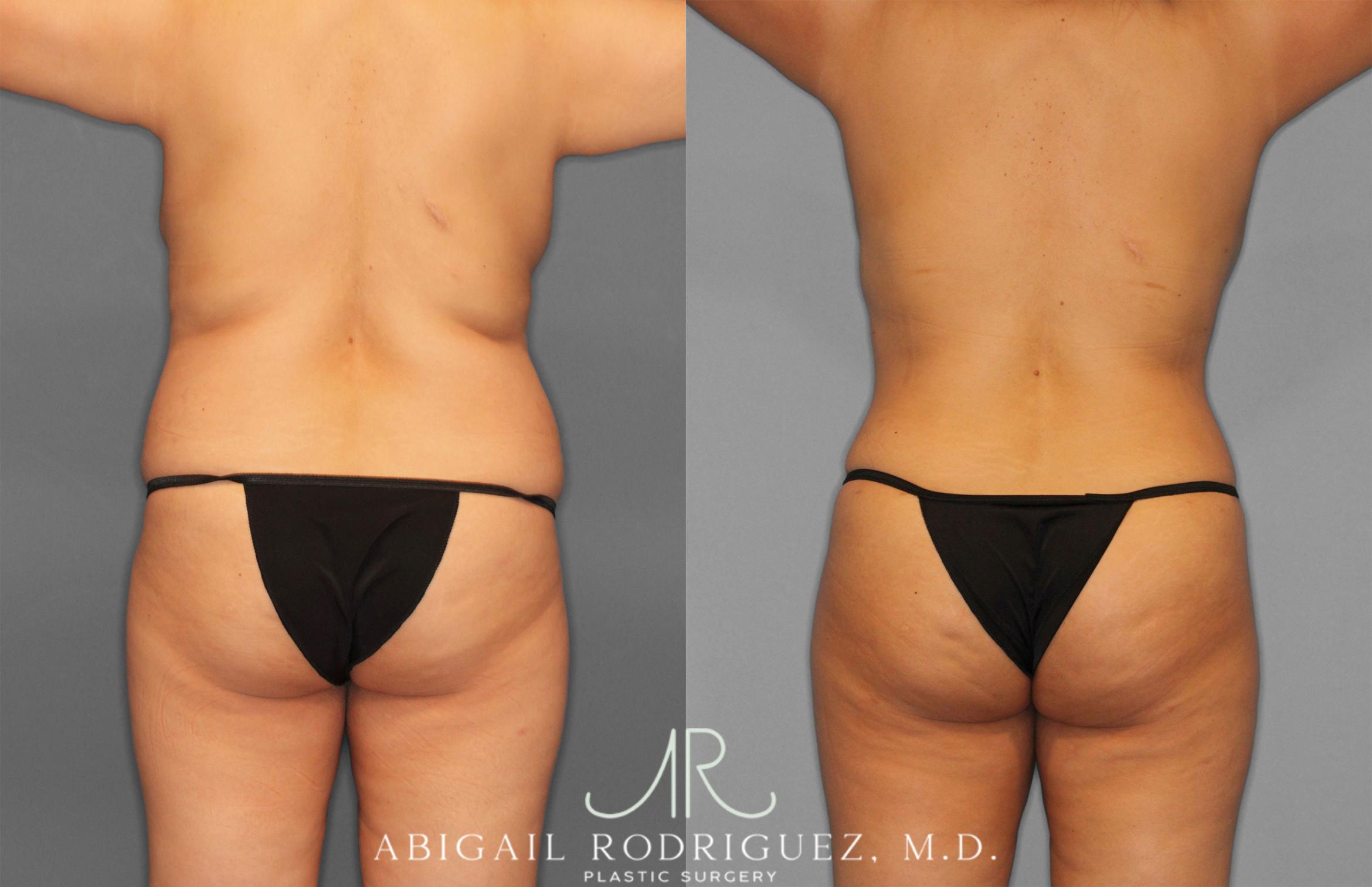 Before & After Tummy Tuck Case 258309 View 6 View in Houston, TX