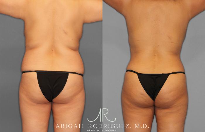 Before & After Tummy Tuck Case 258309 View 6 View in Houston, TX