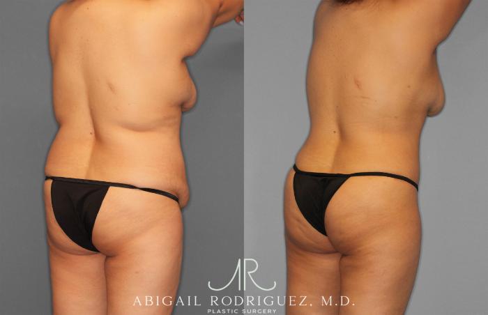 Before & After Tummy Tuck Case 258309 View 7 View in Houston, TX