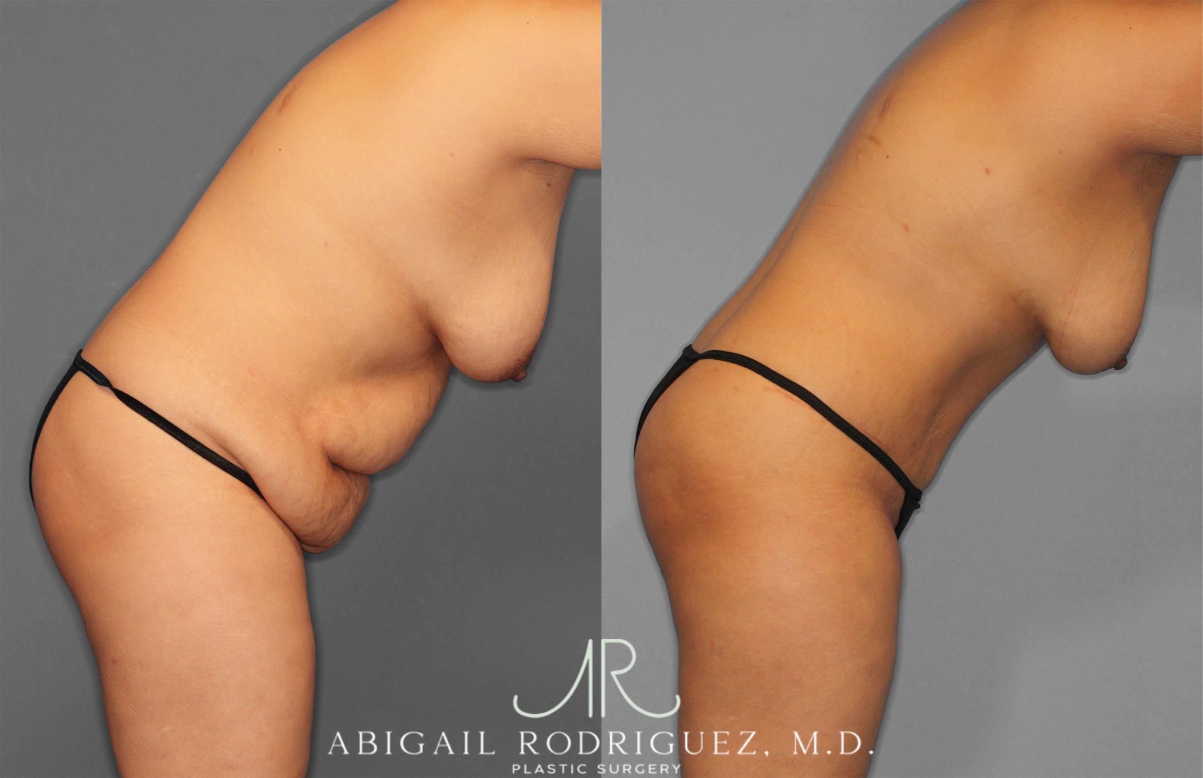Before & After Tummy Tuck Case 258309 View 8 View in Houston, TX