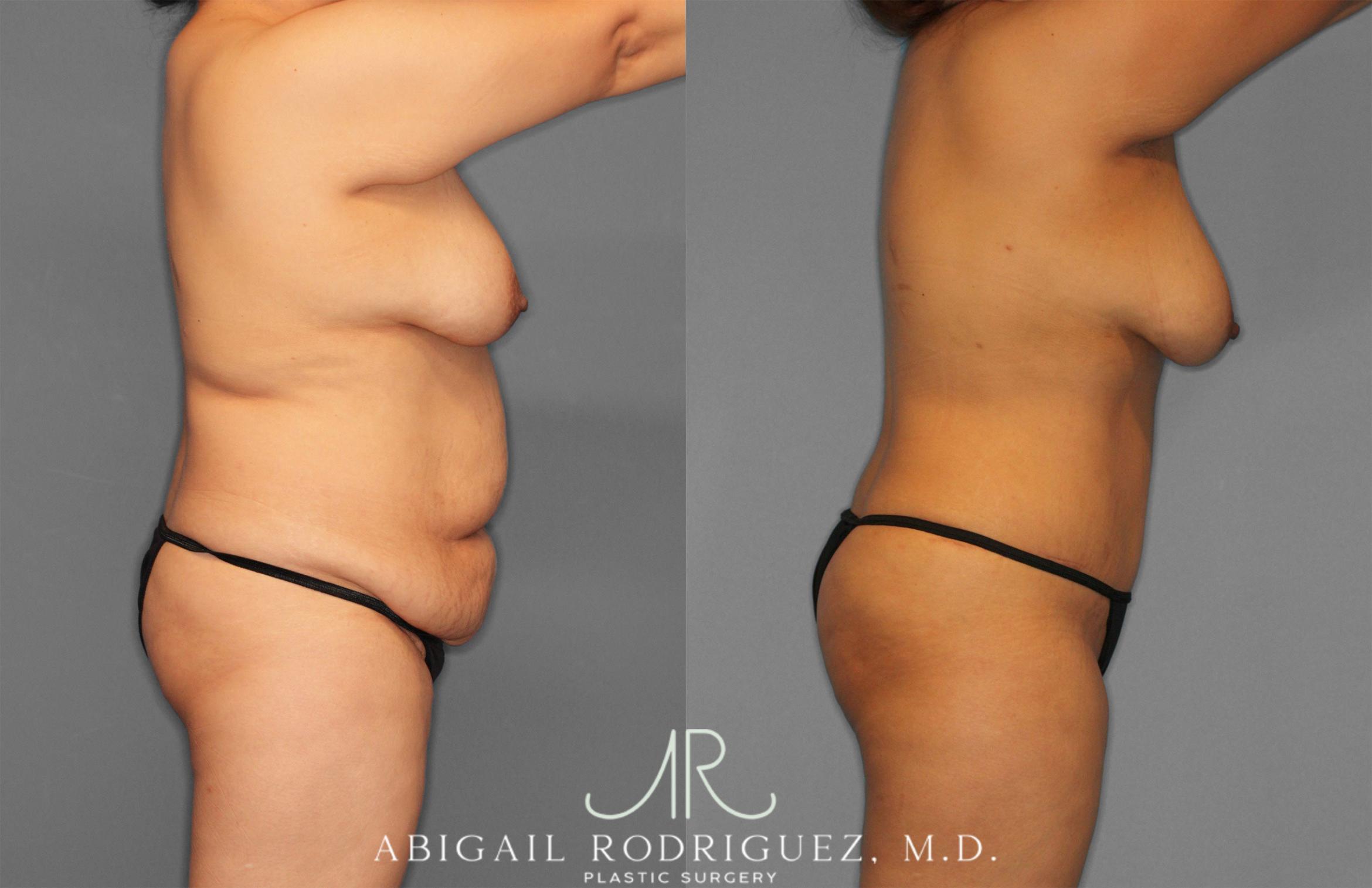 Before & After Tummy Tuck Case 258309 View 9 View in Houston, TX