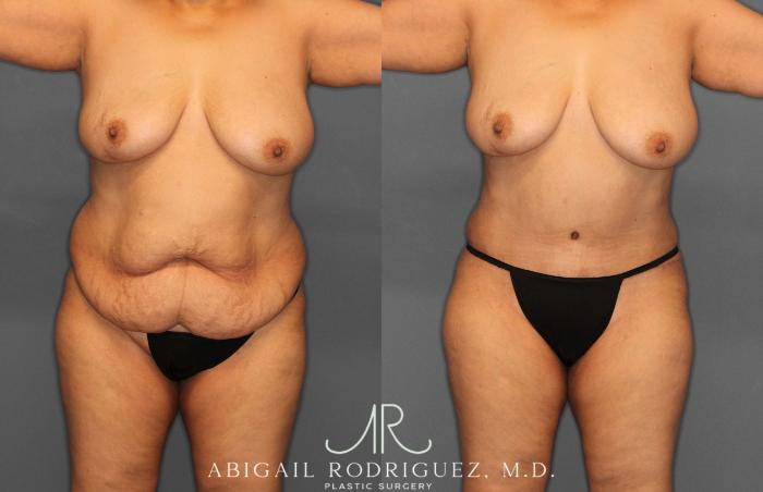Before & After Tummy Tuck Case 258349 View 1 View in Houston, TX