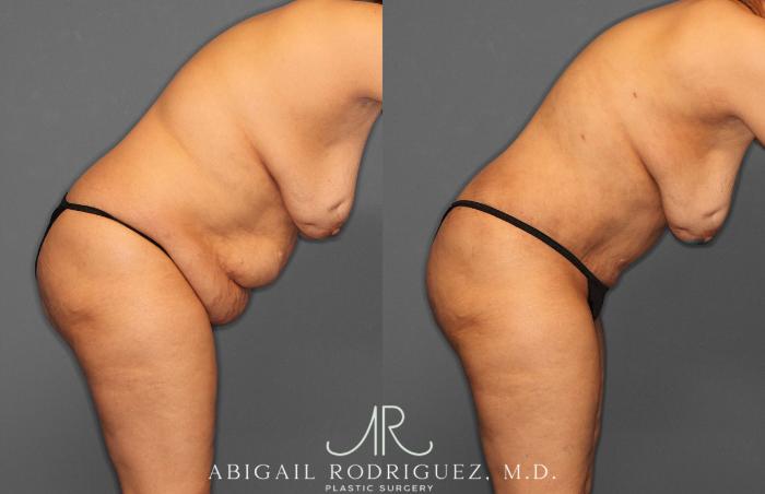 Before & After Tummy Tuck Case 258349 View 10 View in Houston, TX