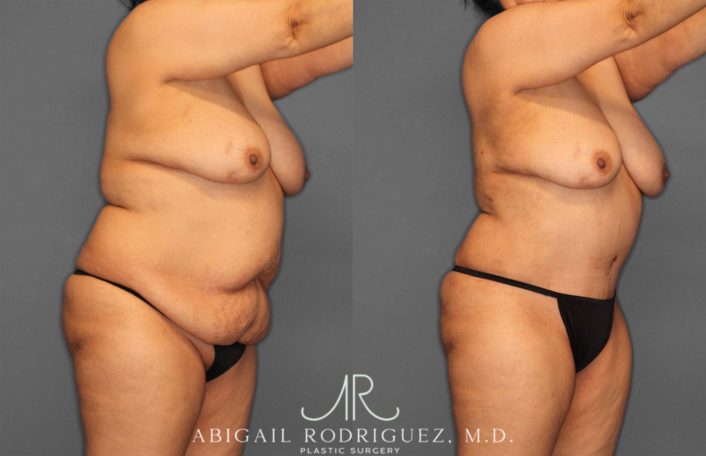 Before & After Tummy Tuck Case 258349 View 2 View in Houston, TX