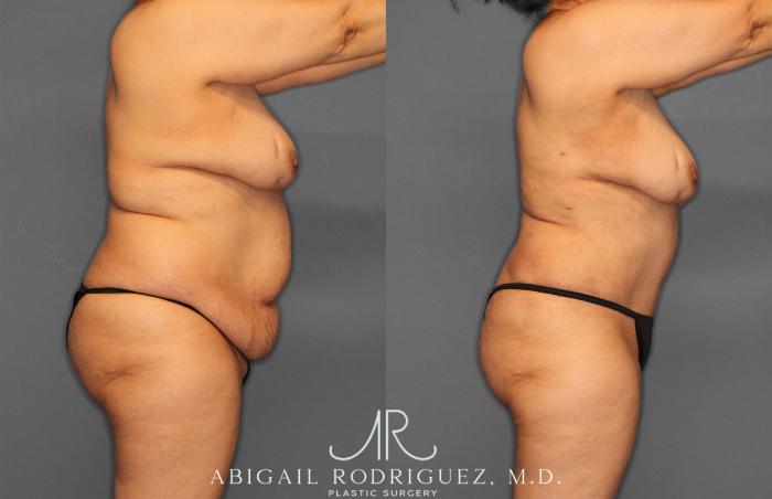 Before & After Tummy Tuck Case 258349 View 3 View in Houston, TX