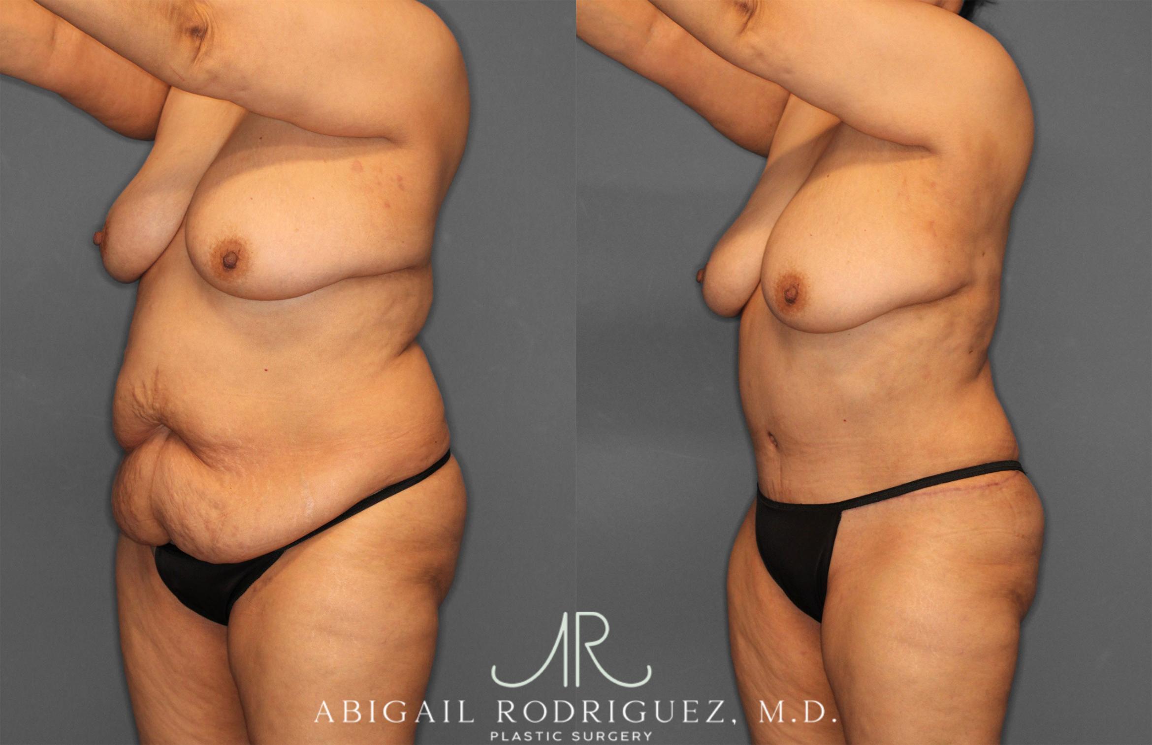 Before & After Tummy Tuck Case 258349 View 4 View in Houston, TX