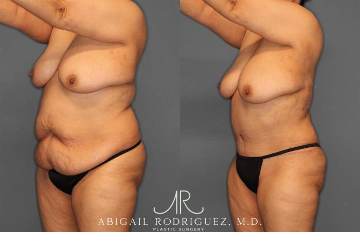 Before & After Tummy Tuck Case 258349 View 4 View in Houston, TX