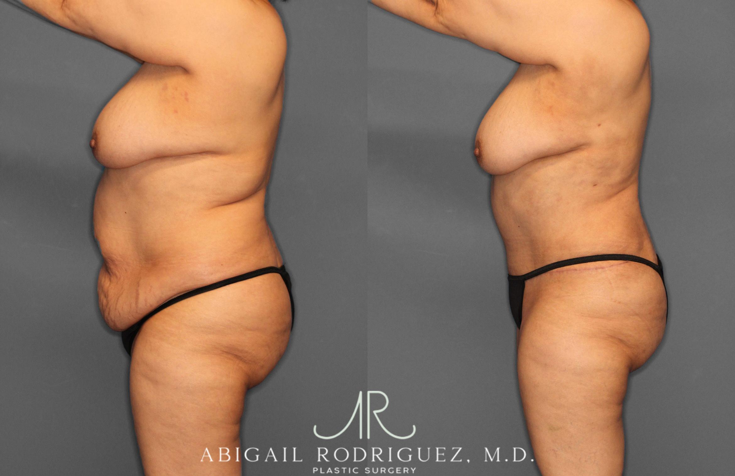 Before & After Tummy Tuck Case 258349 View 5 View in Houston, TX