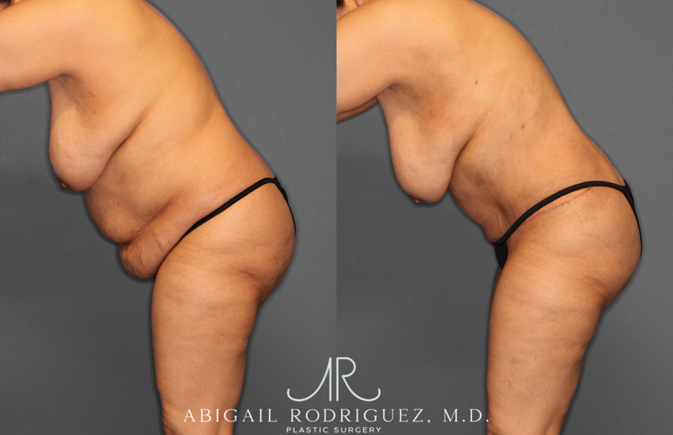 Before & After Tummy Tuck Case 258349 View 6 View in Houston, TX