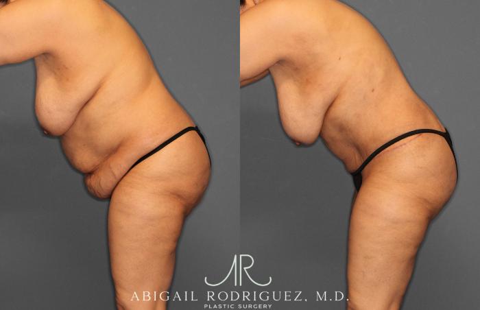 Before & After Tummy Tuck Case 258349 View 6 View in Houston, TX