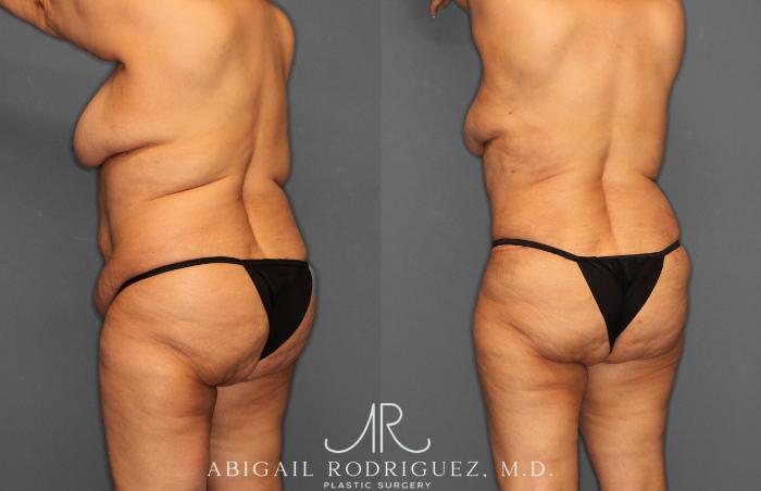 Before & After Tummy Tuck Case 258349 View 7 View in Houston, TX