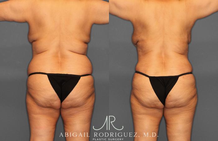 Before & After Tummy Tuck Case 258349 View 8 View in Houston, TX