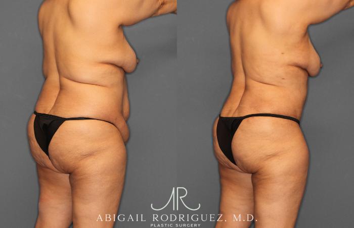 Before & After Tummy Tuck Case 258349 View 9 View in Houston, TX
