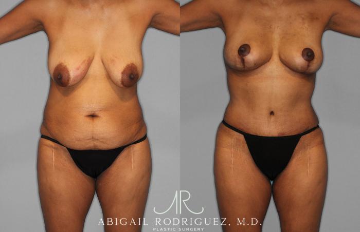 Before & After Tummy Tuck Case 258399 View 1 View in Houston, TX