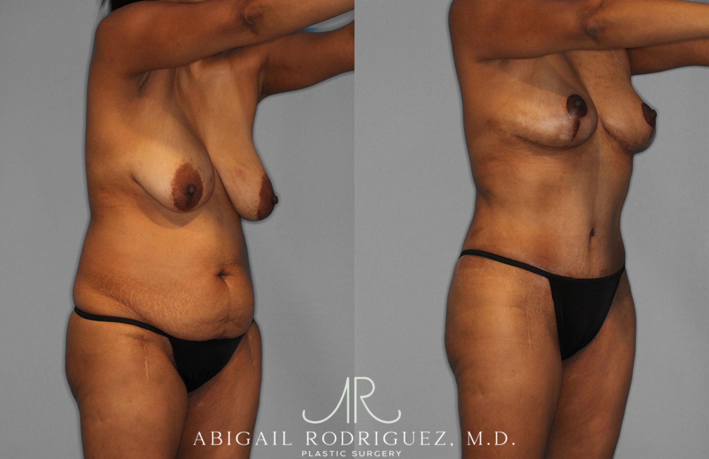 Before & After Tummy Tuck Case 258399 View 10 View in Houston, TX