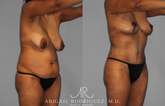 Before & After Tummy Tuck Case 258399 View 10 View in Houston, TX
