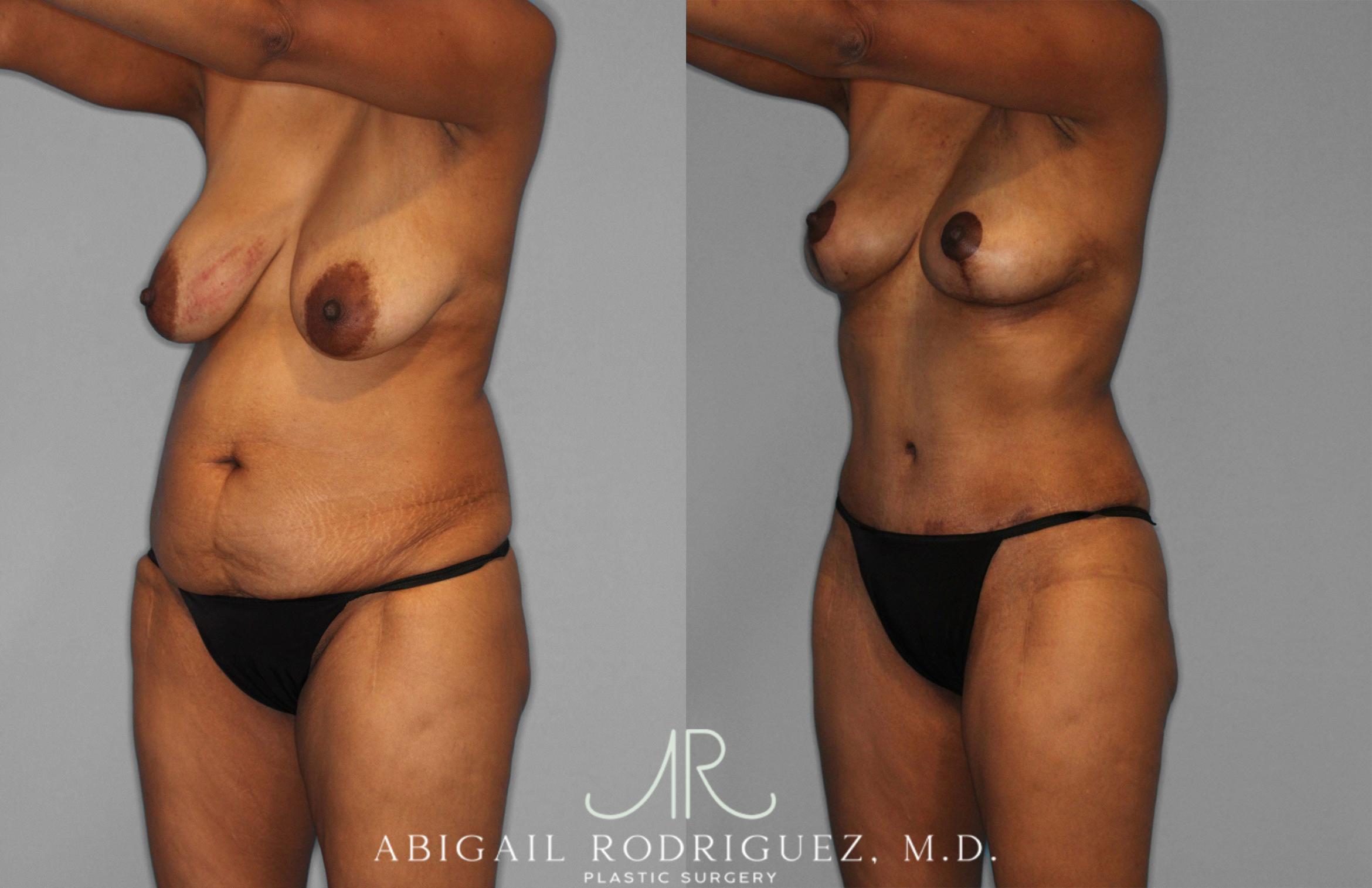 Before & After Tummy Tuck Case 258399 View 2 View in Houston, TX