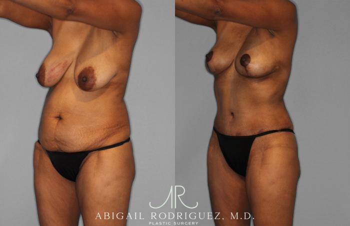 Before & After Tummy Tuck Case 258399 View 2 View in Houston, TX