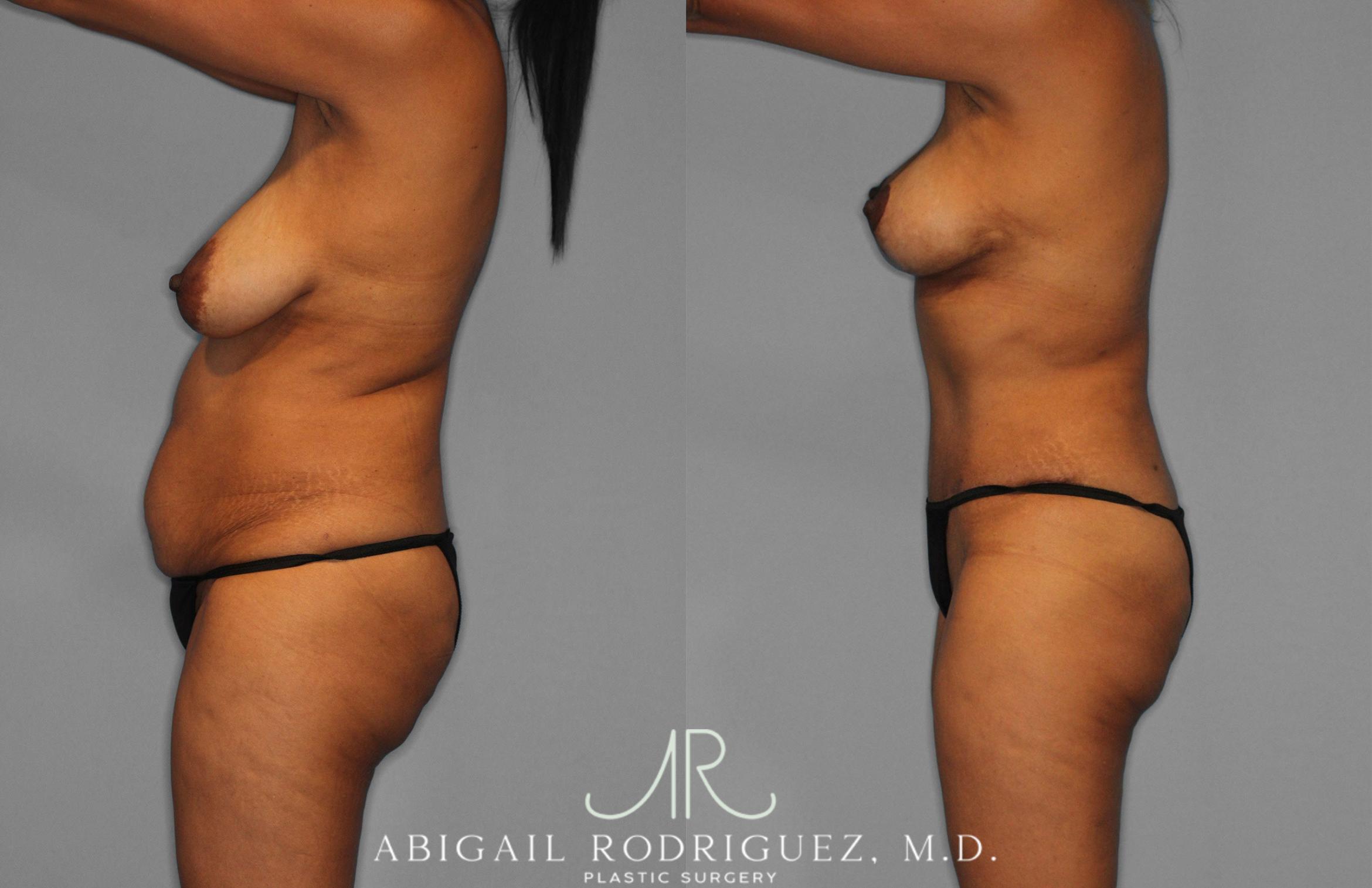 Before & After Tummy Tuck Case 258399 View 3 View in Houston, TX
