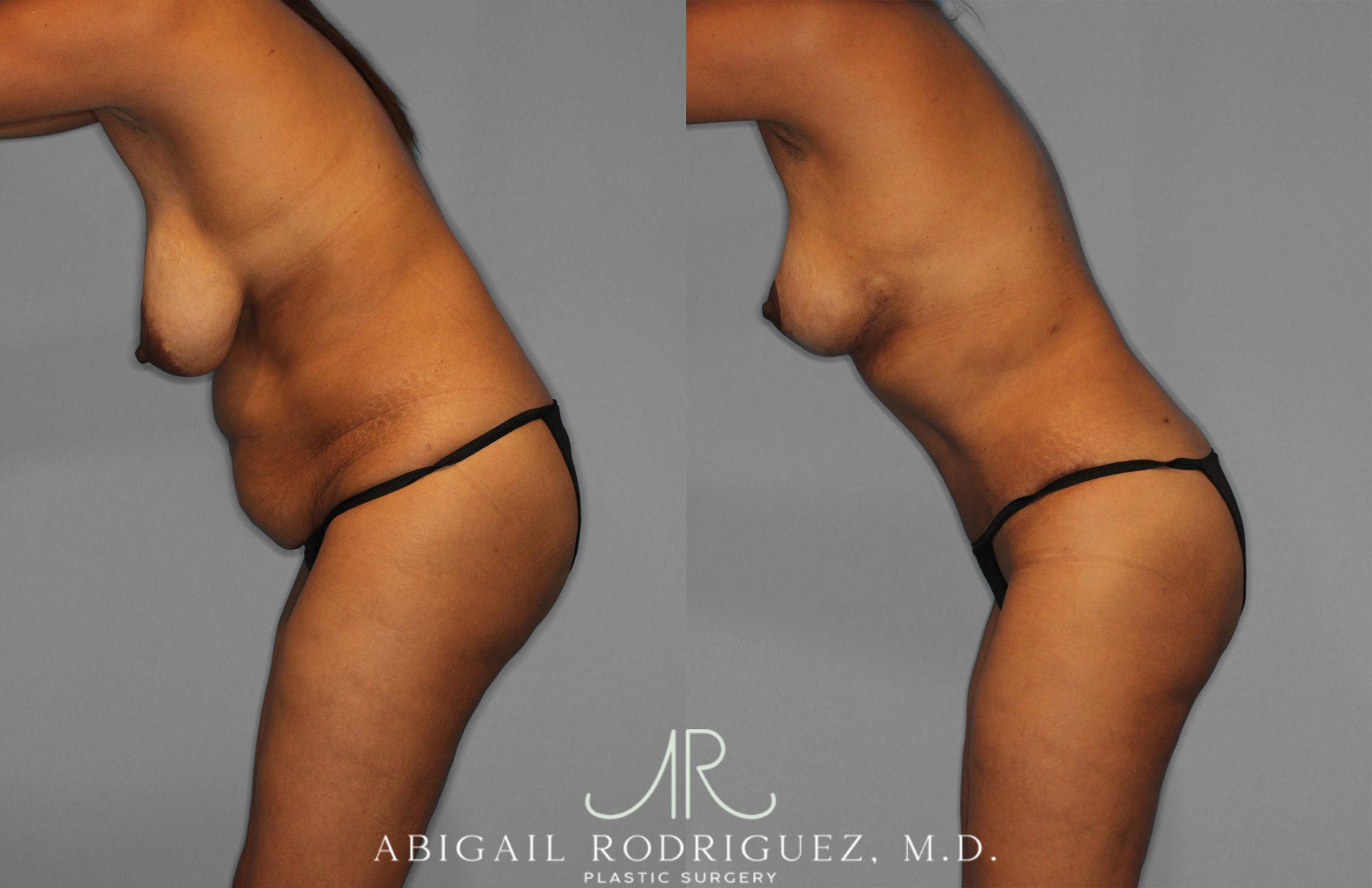 Before & After Tummy Tuck Case 258399 View 4 View in Houston, TX