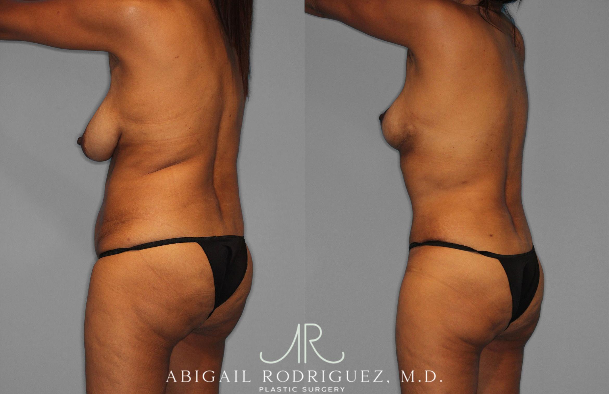 Before & After Tummy Tuck Case 258399 View 5 View in Houston, TX