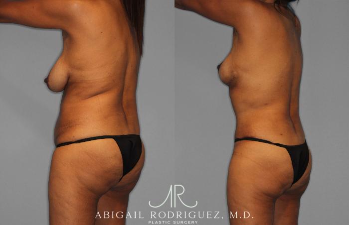 Before & After Tummy Tuck Case 258399 View 5 View in Houston, TX