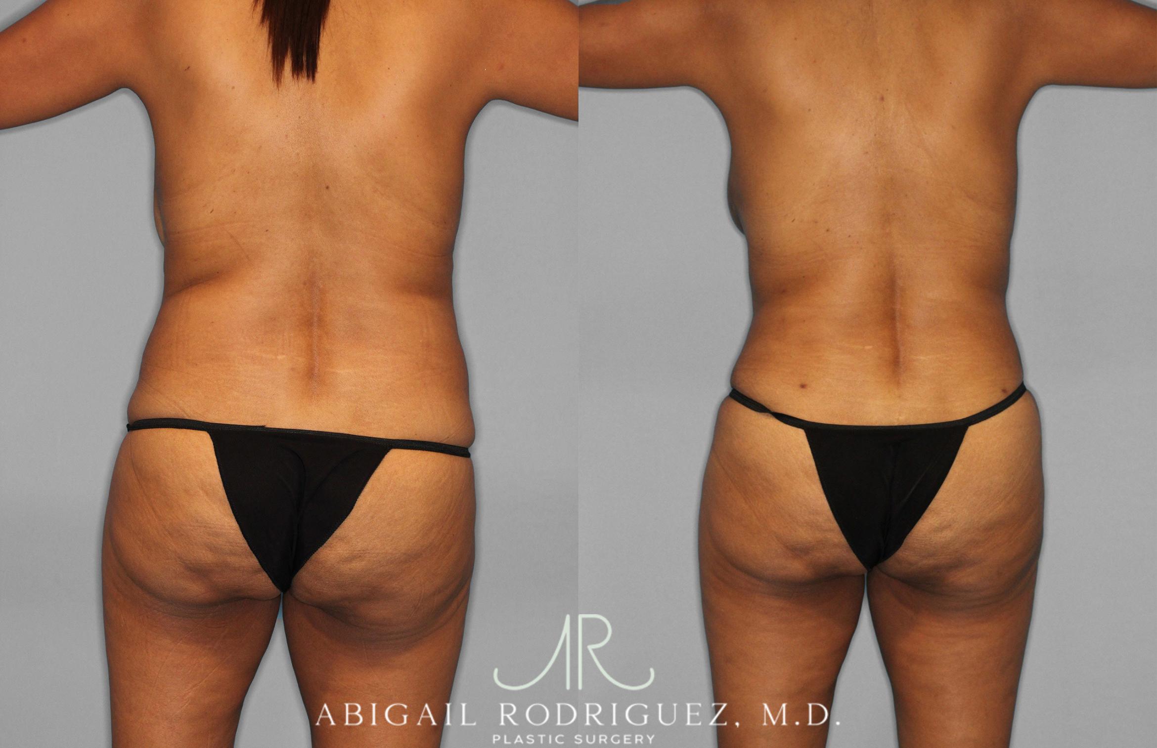 Before & After Tummy Tuck Case 258399 View 6 View in Houston, TX