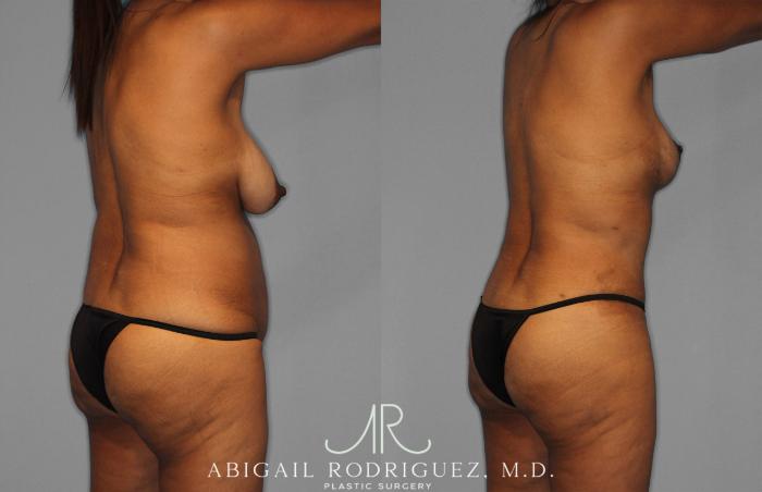 Before & After Tummy Tuck Case 258399 View 7 View in Houston, TX