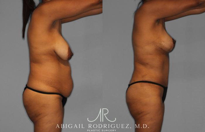 Before & After Tummy Tuck Case 258399 View 8 View in Houston, TX