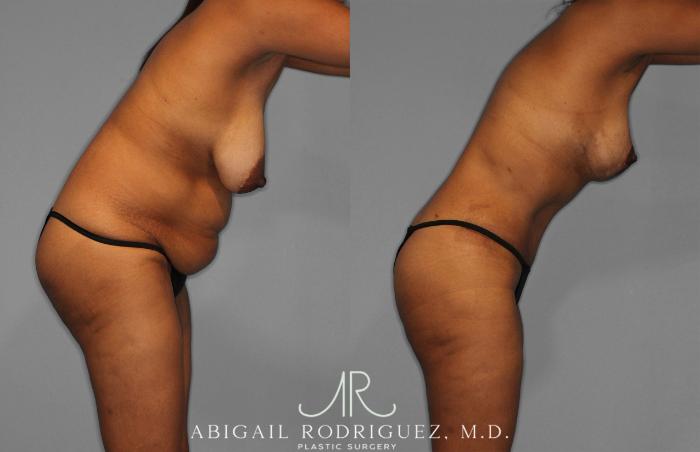 Before & After Tummy Tuck Case 258399 View 9 View in Houston, TX