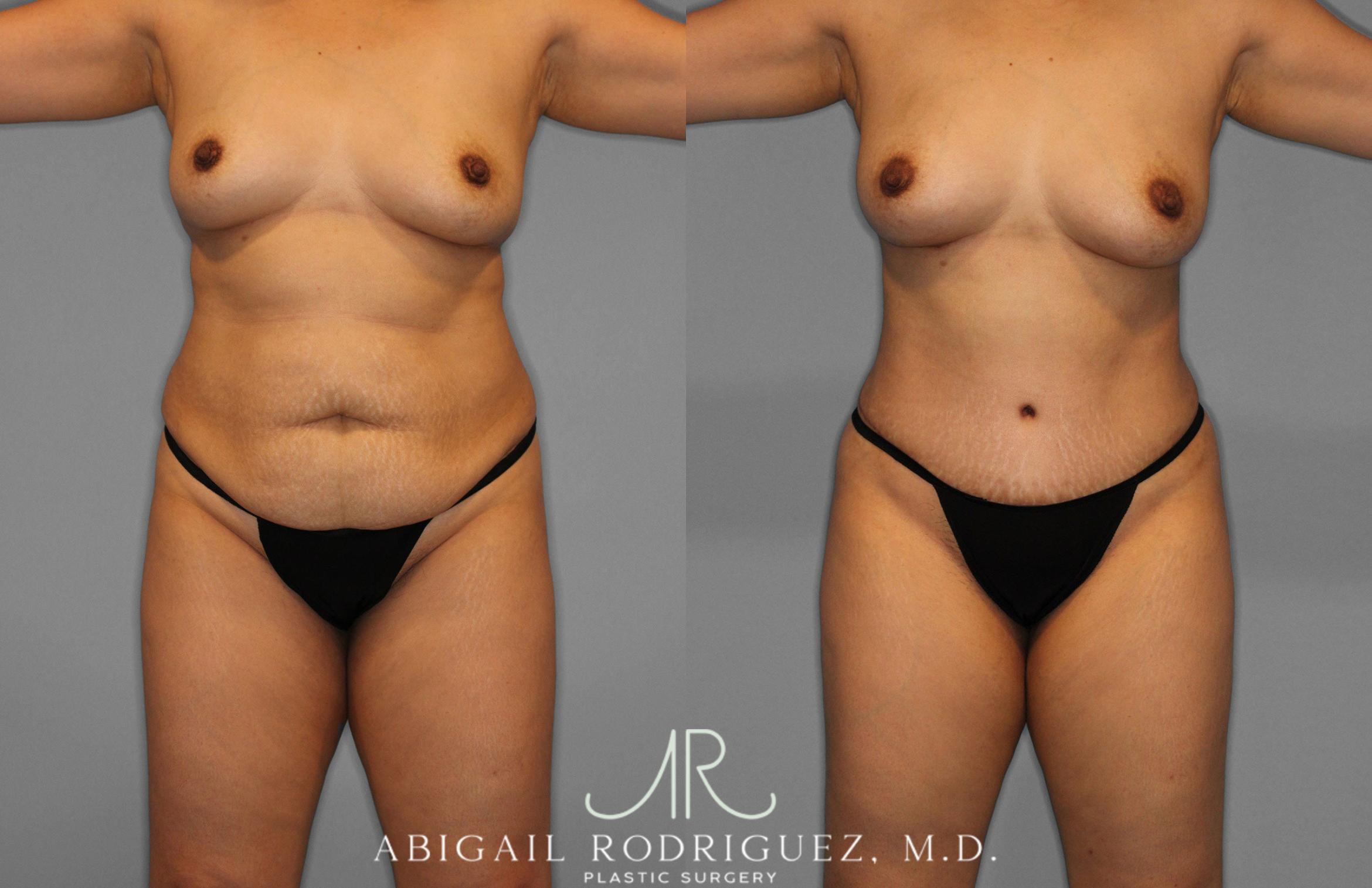 Before & After Tummy Tuck Case 258419 View 1 View in Houston, TX