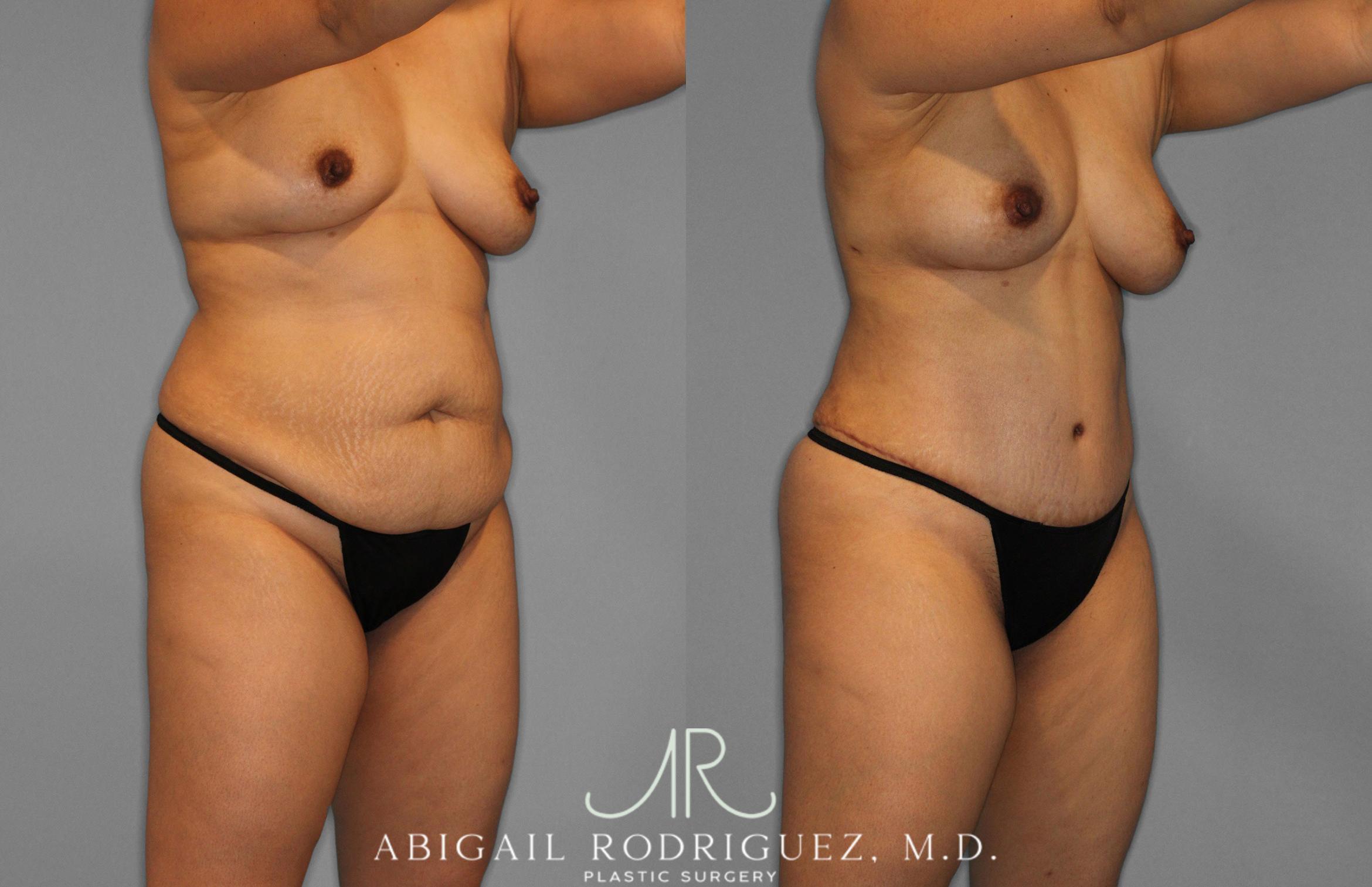 Before & After Tummy Tuck Case 258419 View 10 View in Houston, TX