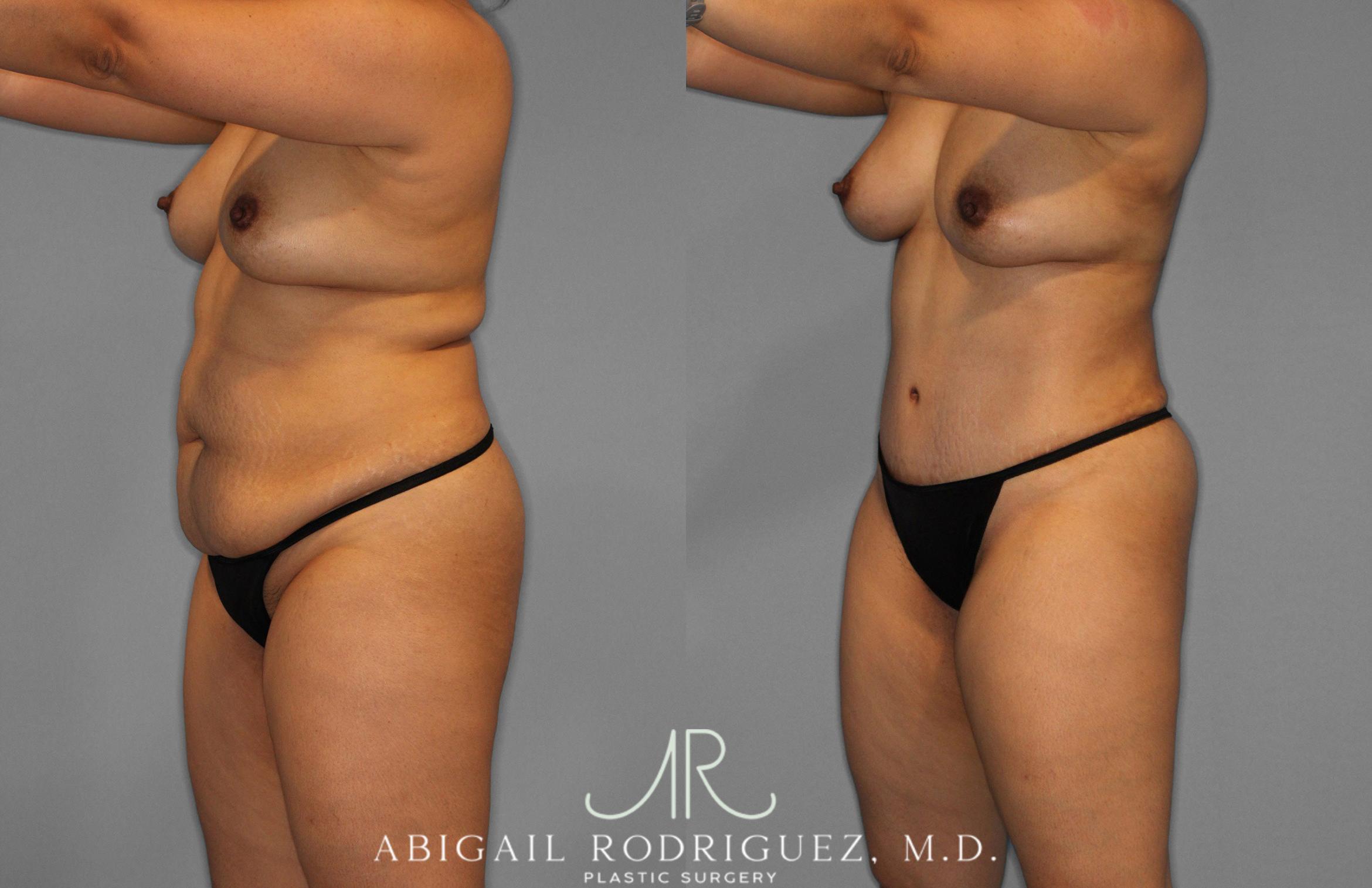 Before & After Tummy Tuck Case 258419 View 2 View in Houston, TX