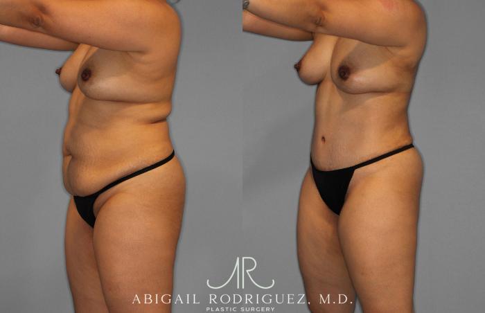 Before & After Tummy Tuck Case 258419 View 2 View in Houston, TX