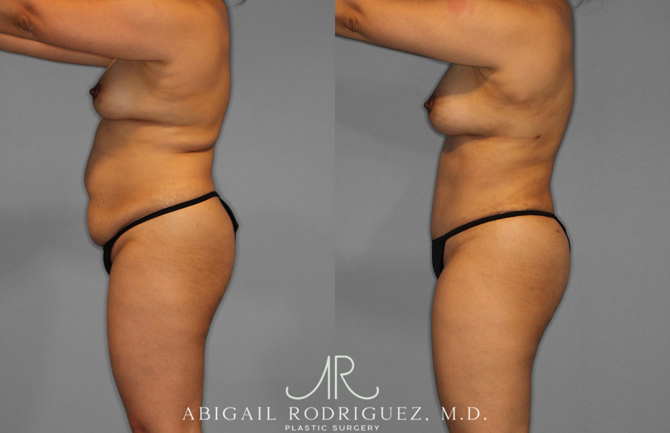 Before & After Tummy Tuck Case 258419 View 3 View in Houston, TX