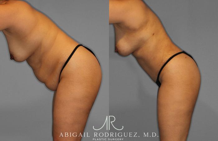 Before & After Tummy Tuck Case 258419 View 4 View in Houston, TX