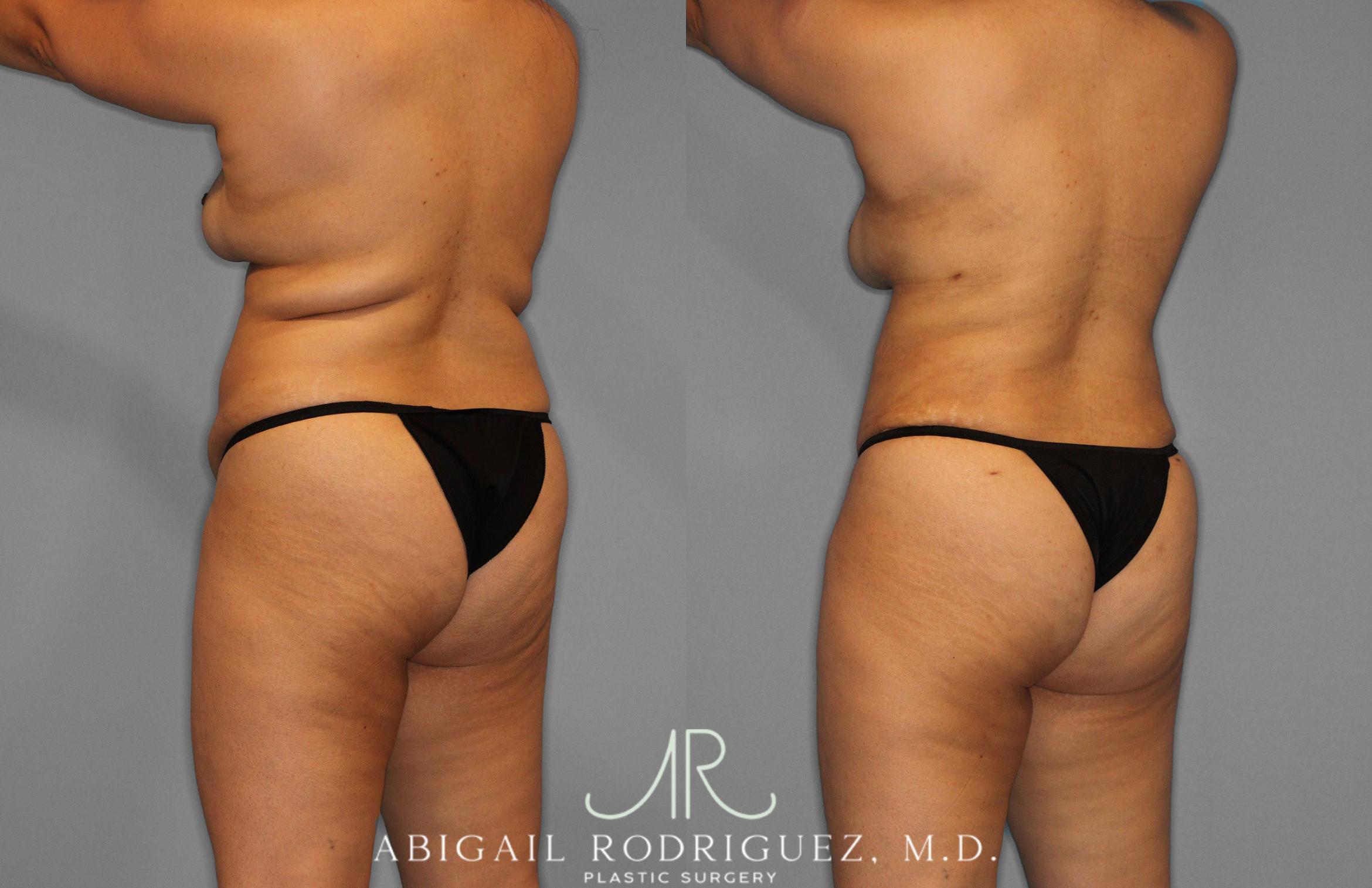 Before & After Tummy Tuck Case 258419 View 5 View in Houston, TX