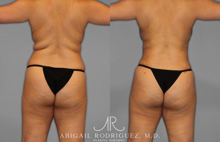 Before & After Tummy Tuck Case 258419 View 6 View in Houston, TX