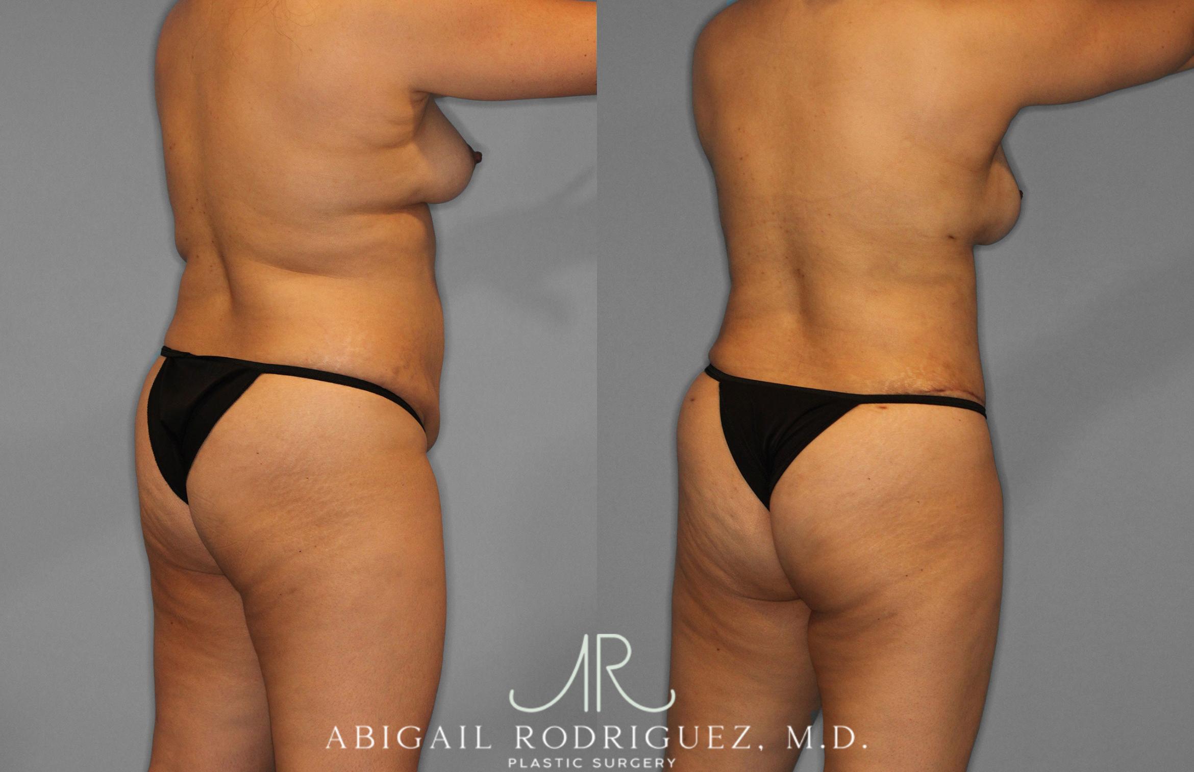 Before & After Tummy Tuck Case 258419 View 7 View in Houston, TX