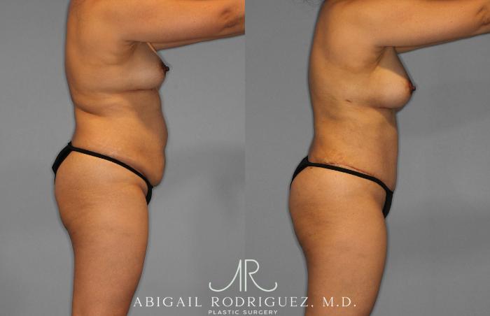 Before & After Tummy Tuck Case 258419 View 8 View in Houston, TX