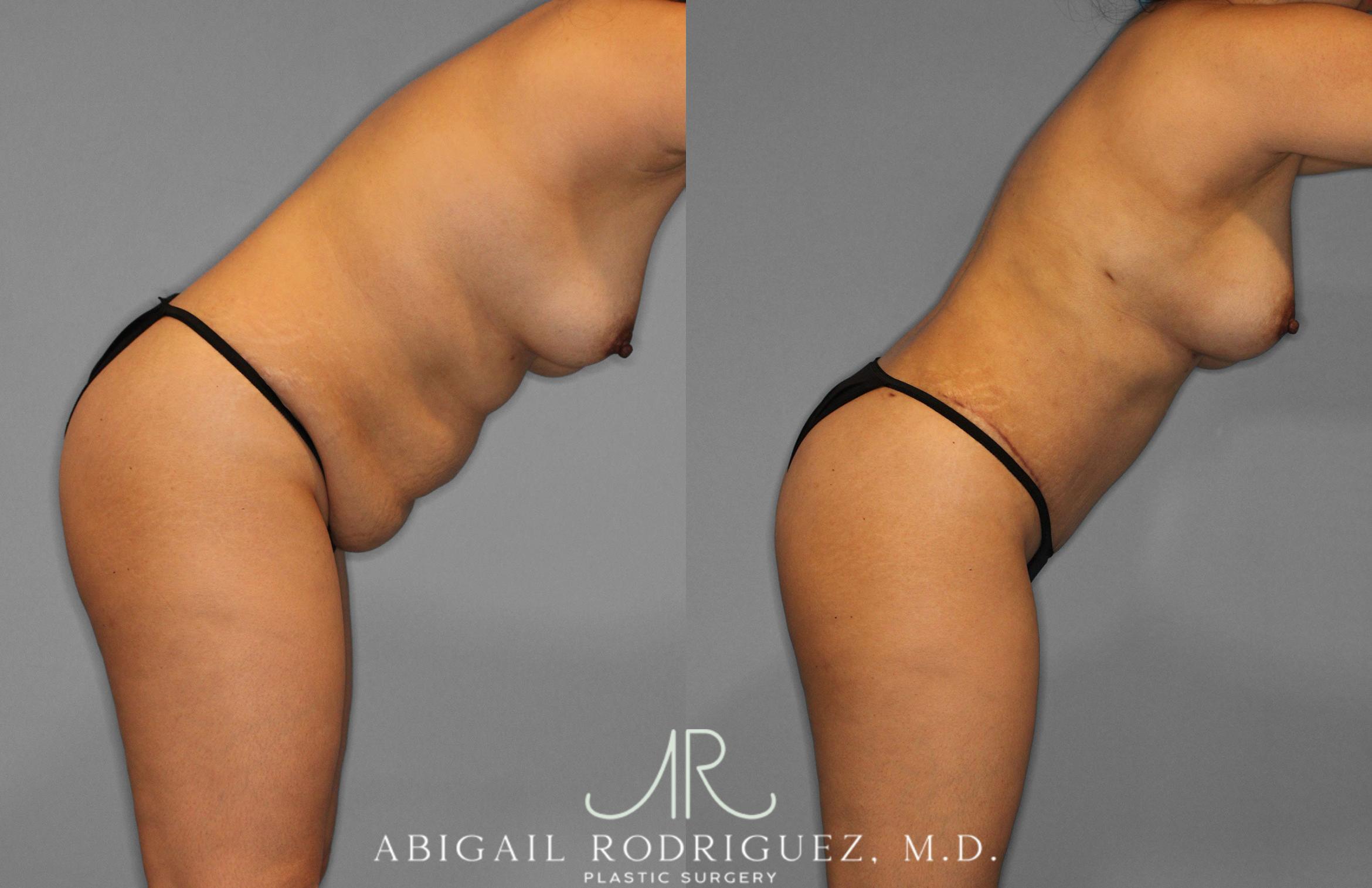 Before & After Tummy Tuck Case 258419 View 9 View in Houston, TX