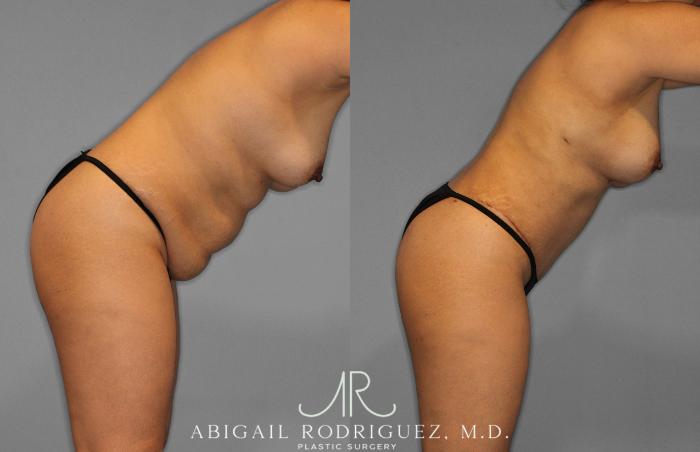 Before & After Tummy Tuck Case 258419 View 9 View in Houston, TX